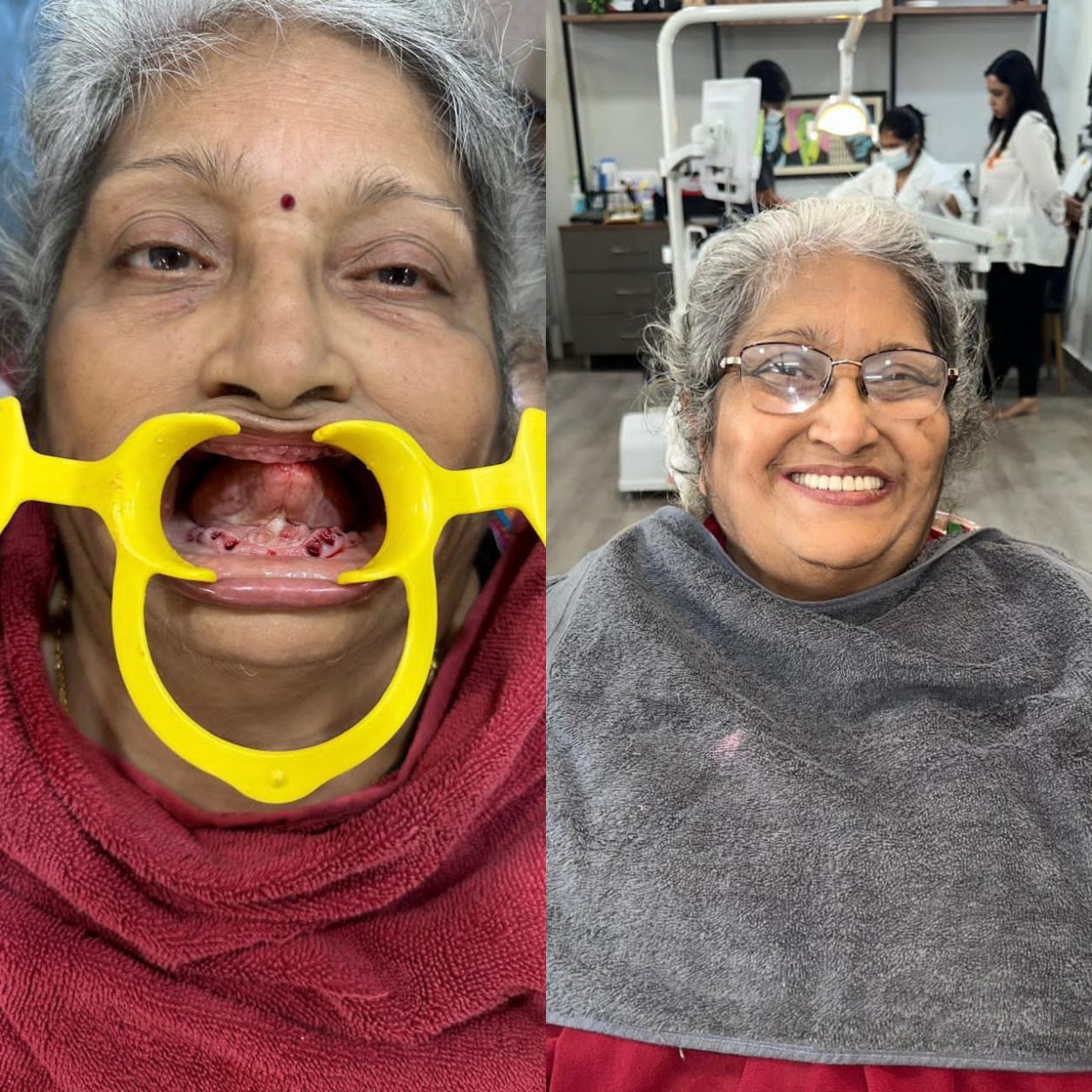 Full Smile Makeover & Restoration