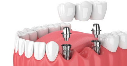 Dental Conventional Implants
