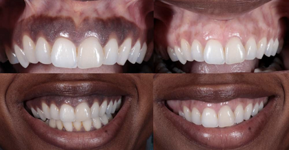Dental Gum Lightening and Reshaping