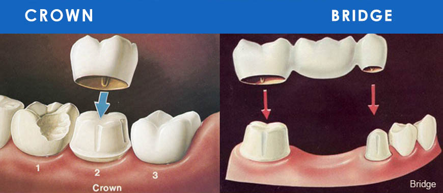 Dental Crown and Bridges