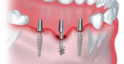 Dental Basal Implants