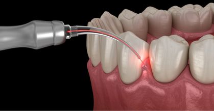 Dental Laser gum surgery