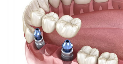 Dental Immediate Implant