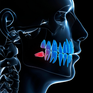 Dental wisdom tooth extraction