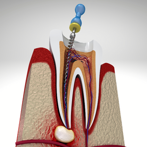 Dental Root Canal Treatment
